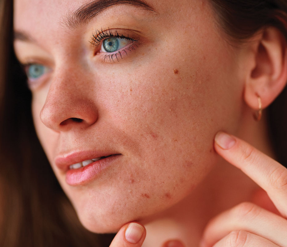 Montrose London - Adult Acne