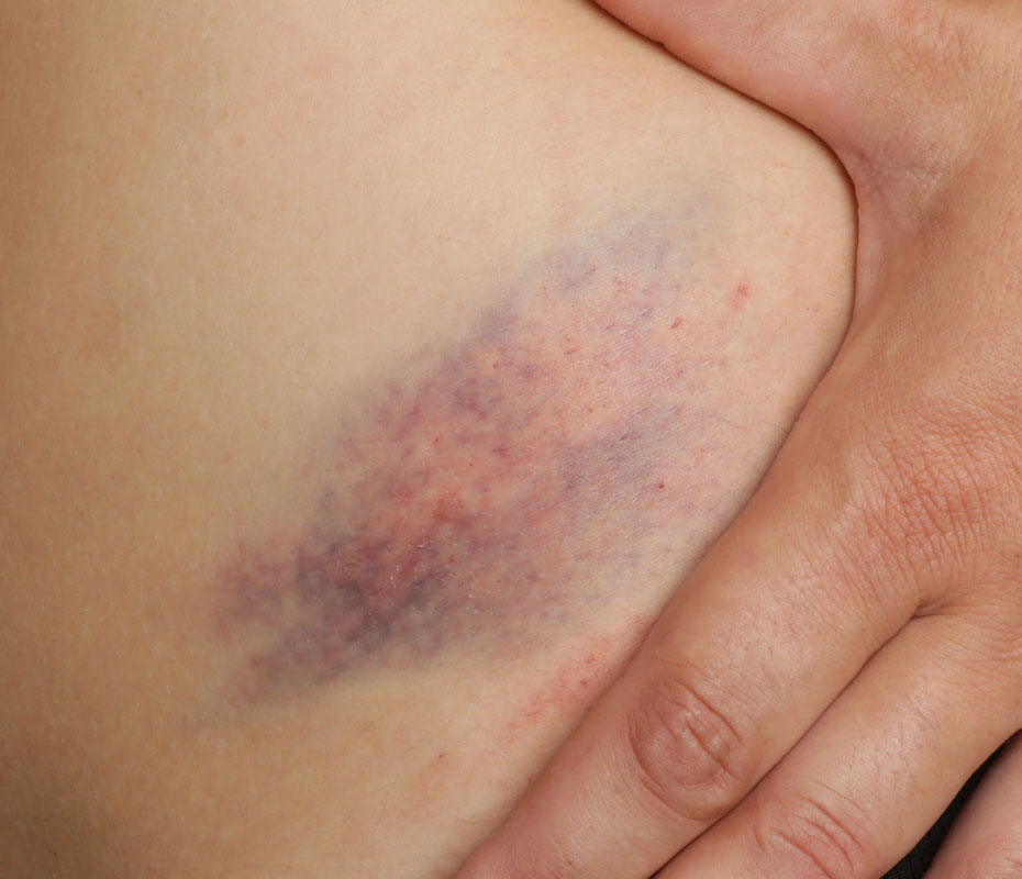 Montrose London - Bruising