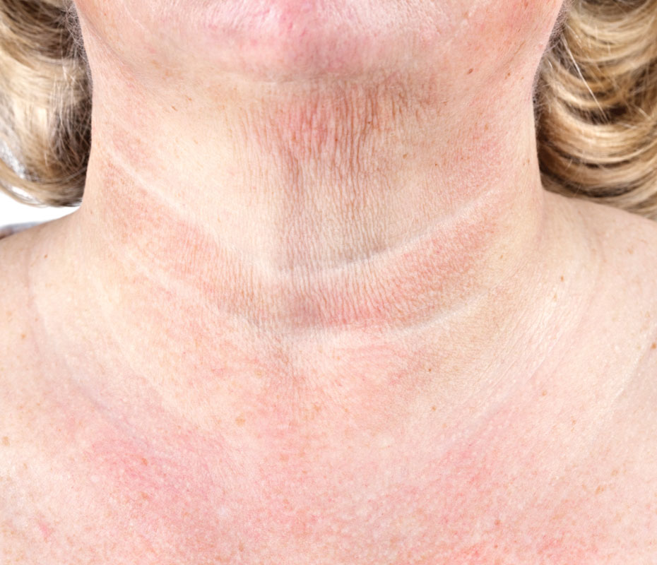 Montrose London - Crepey Skin