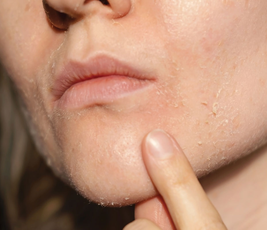 Montrose London - Dermatitis & Dry Skin