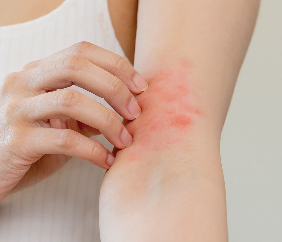 Montrose London - Eczema