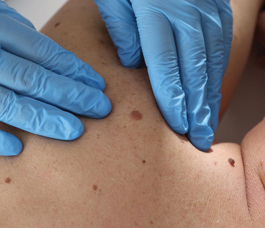 Montrose London - Melanoma