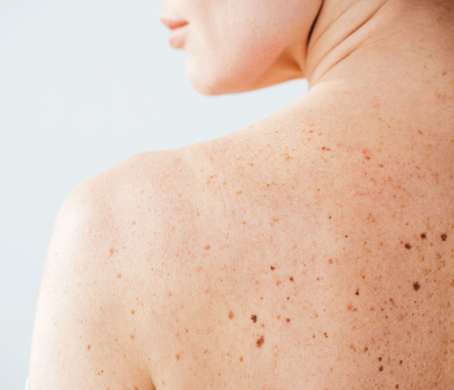 Montrose London - Moles