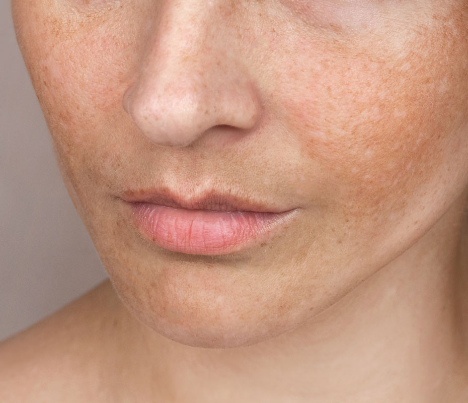 Montrose London - Pigmentation