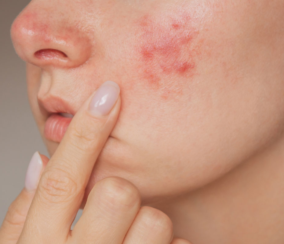 Montrose London - Rosacea