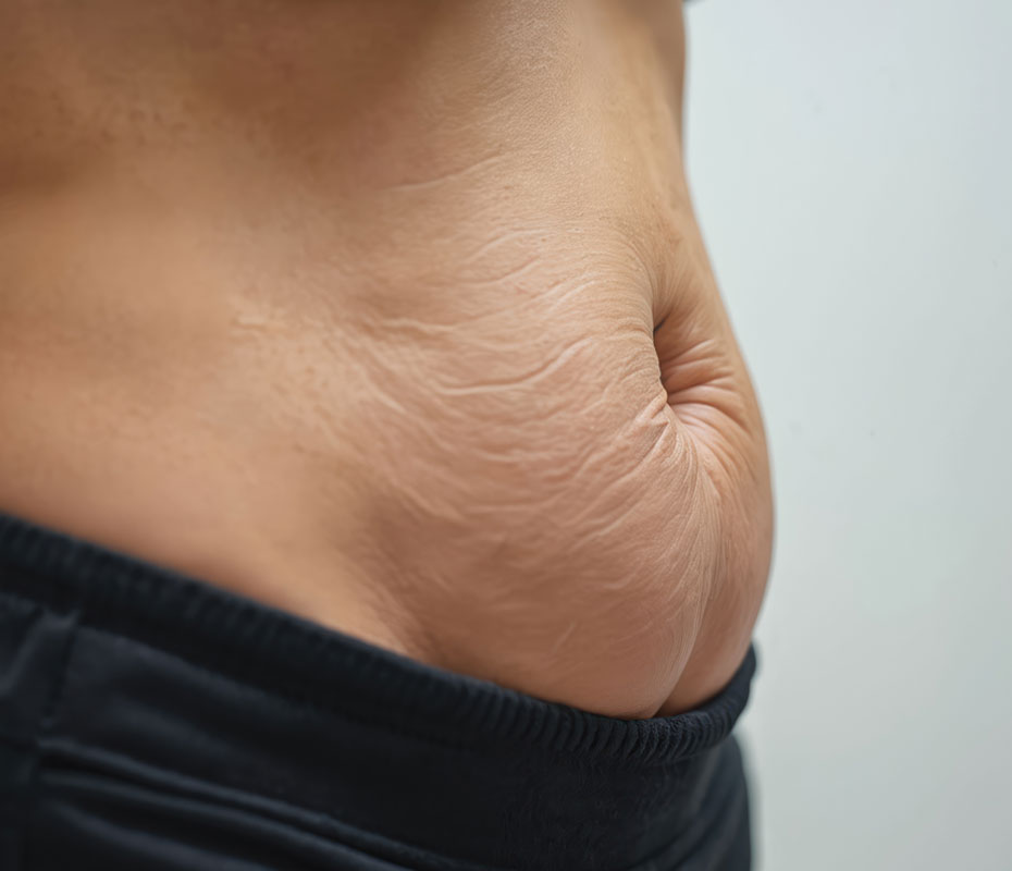 Montrose London - Sagging Abdominal Skin