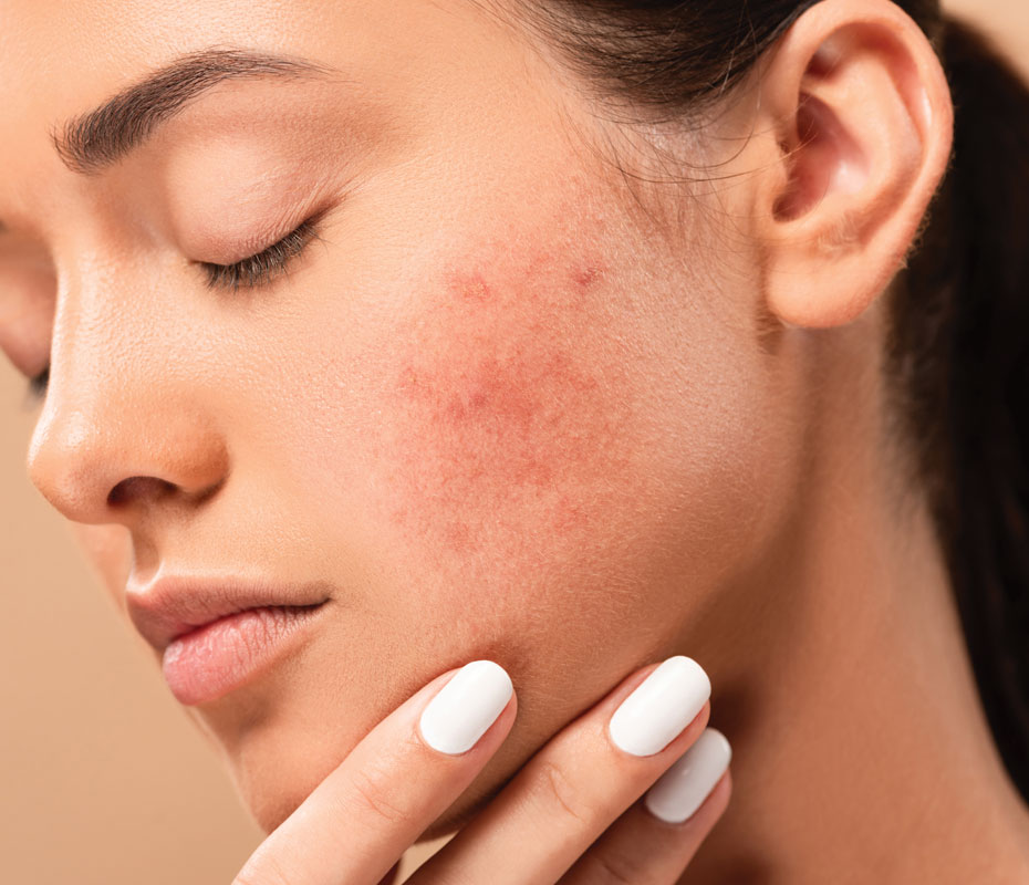 Montrose London - Acne Scarring