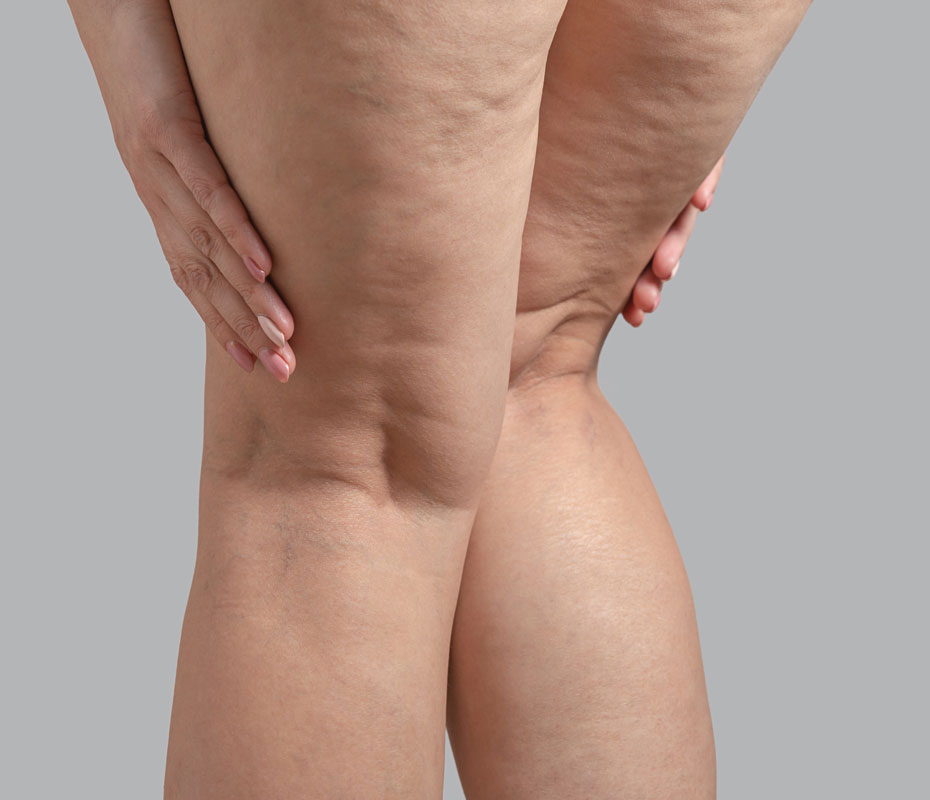 Montrose London - Cellulite