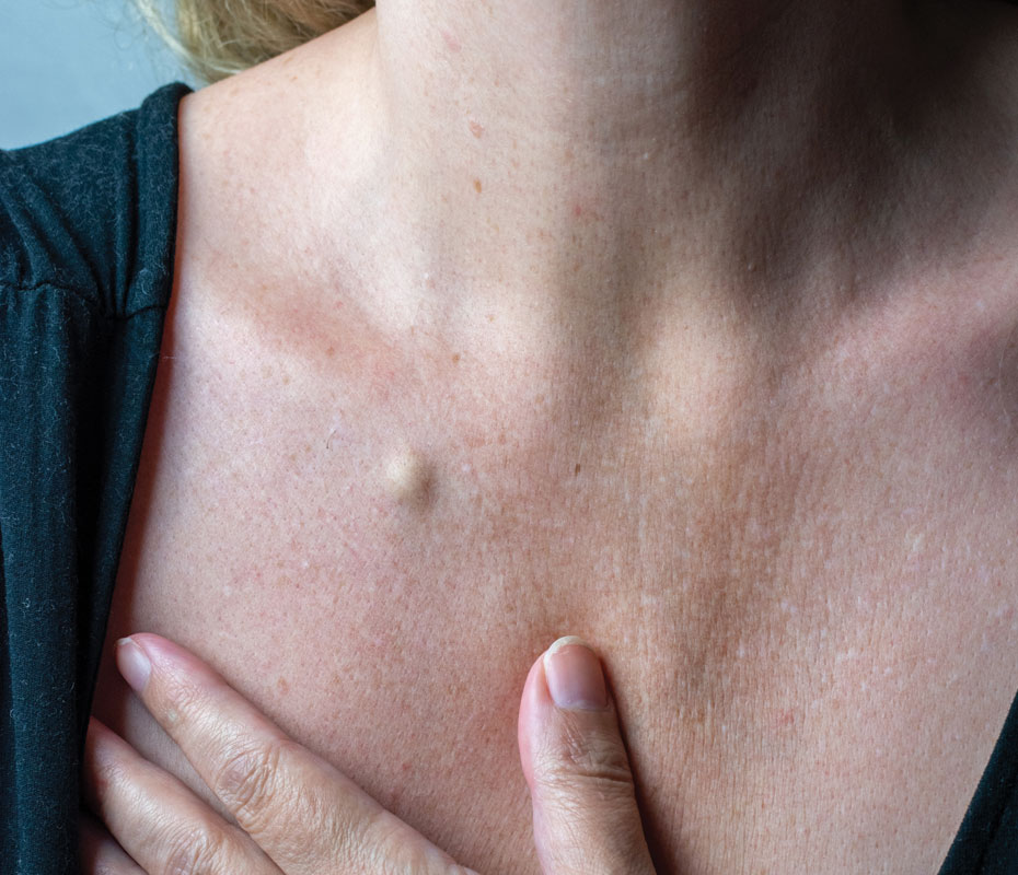 Montrose London - Cysts