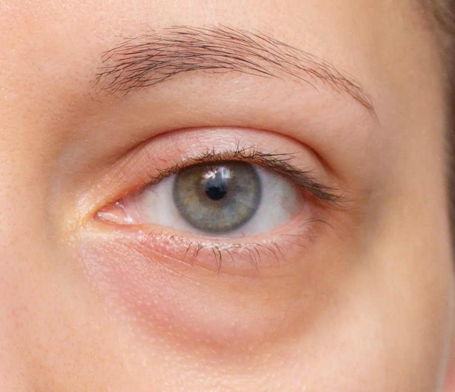 Montrose London - Under-Eye Bags