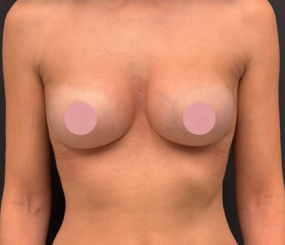 After Breast Implant Exchange Montrose