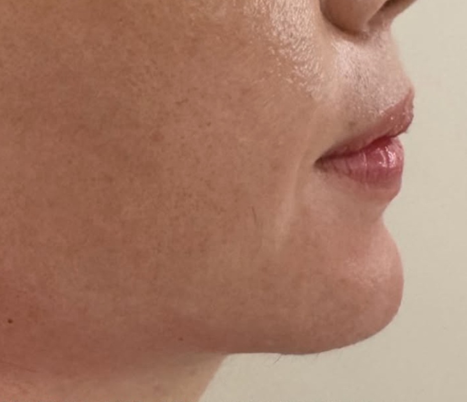 After Chin Augmentation