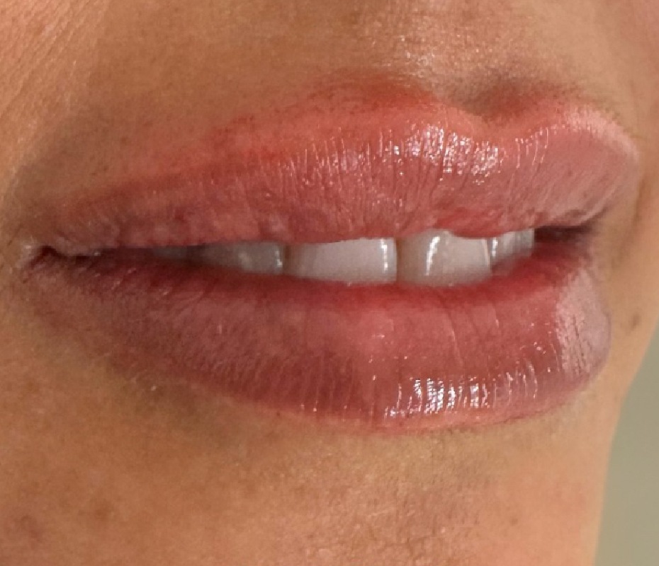 After Lip Filler