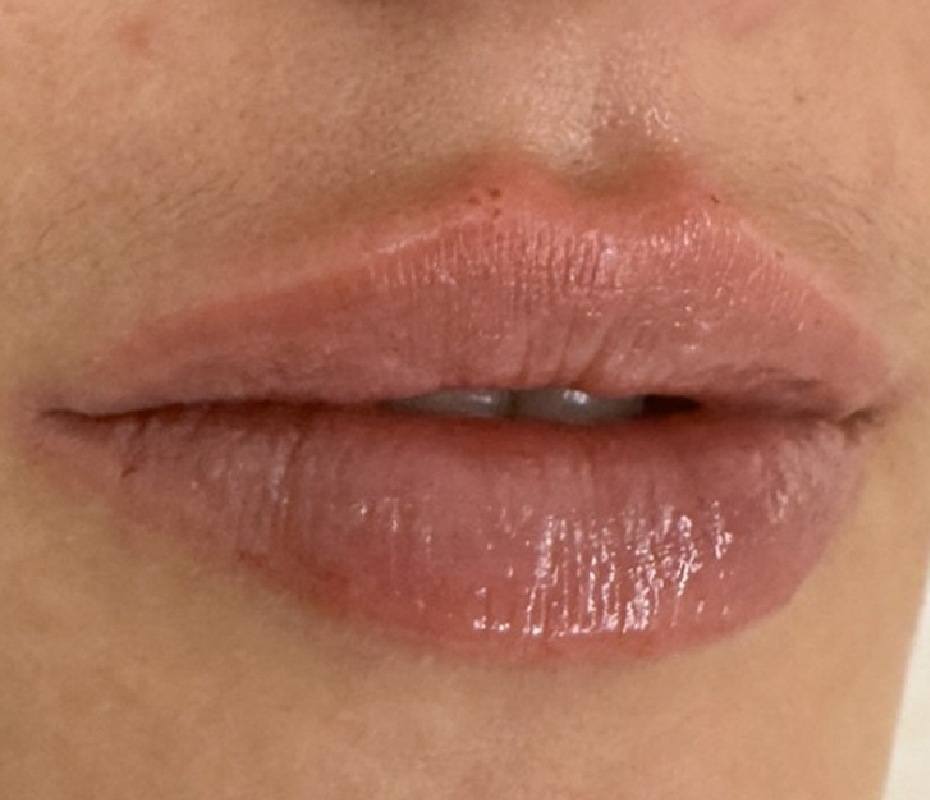 After Lip Filler
