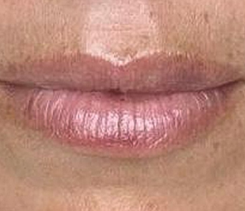 After Lip Filler Montrose