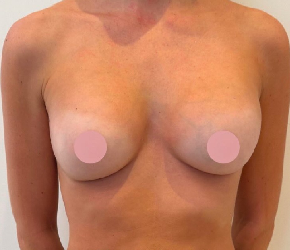 Before Breast Implant Exchange Montrose