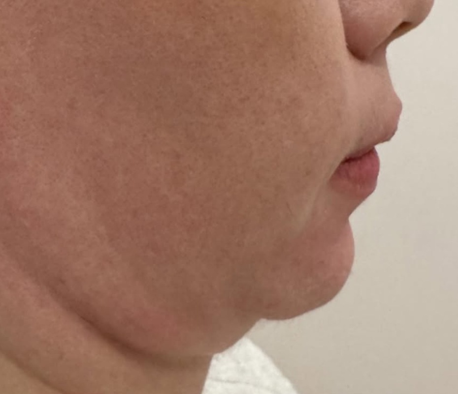 Before Chin Augmentation Montrose