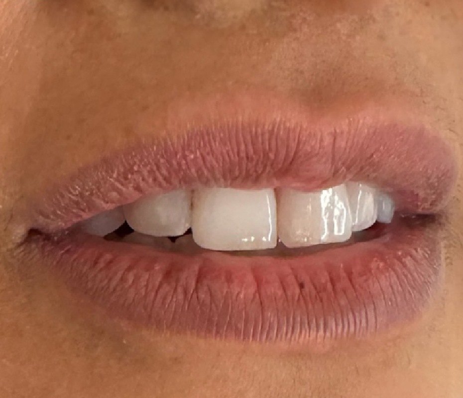 Before Lip Filler