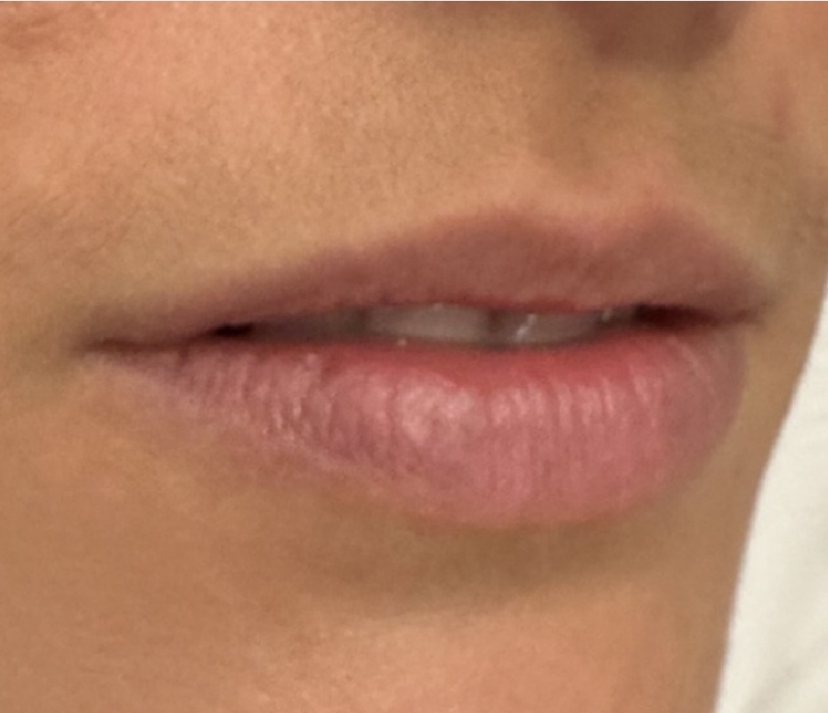 Before Lip Filler