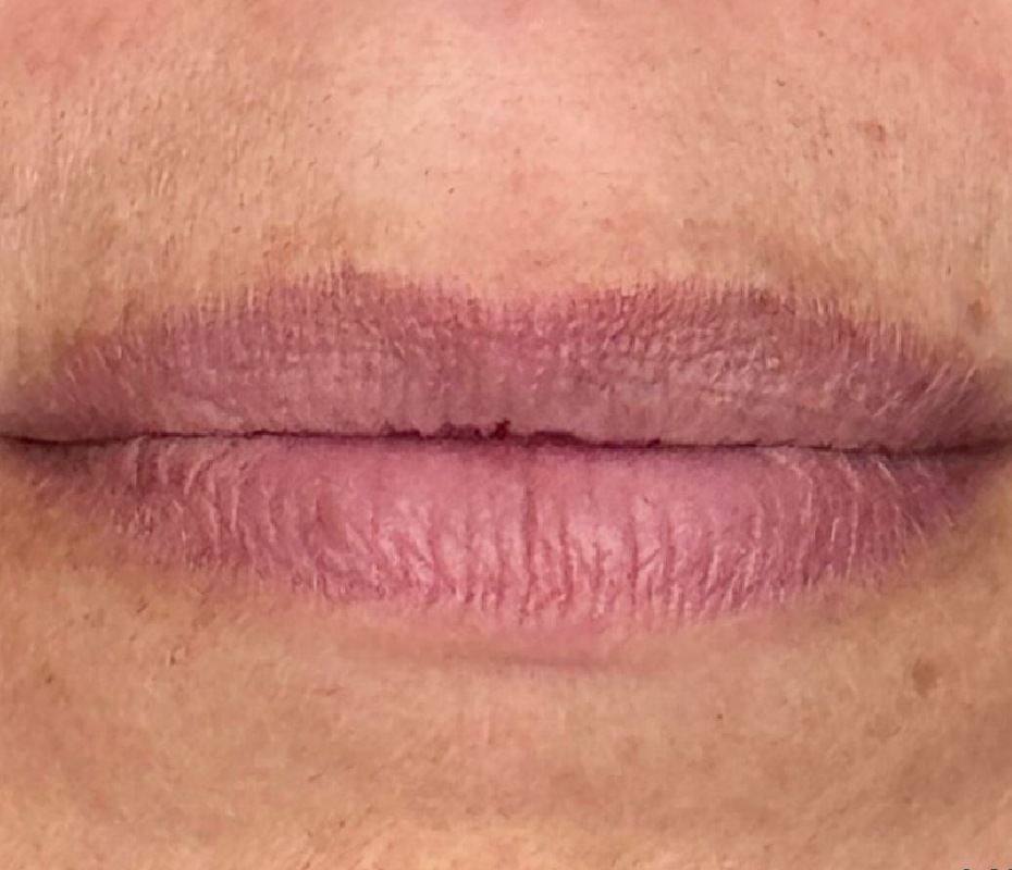 Before Lip Filler Montrose