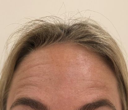 Botox Before Montrose