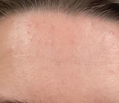 Botox After Montrose
