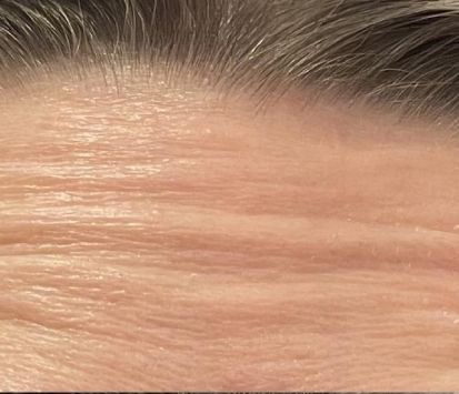 Botox Before Montrose