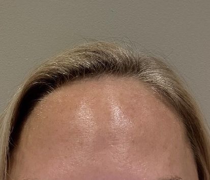 Botox After Montrose