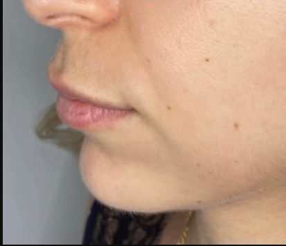 Chin-Fillers-Before-Montrose