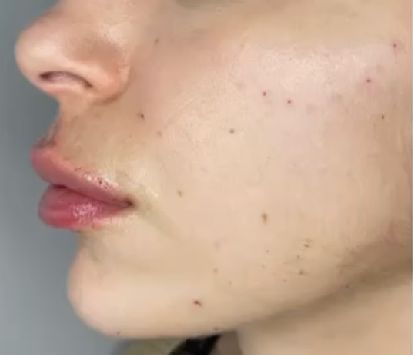 Chin Jaw Cheek Filler After Montrose
