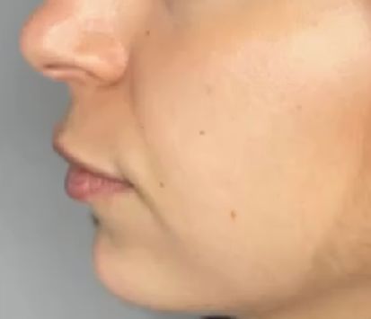 Chin Jaw Cheek Filler Before Montrose