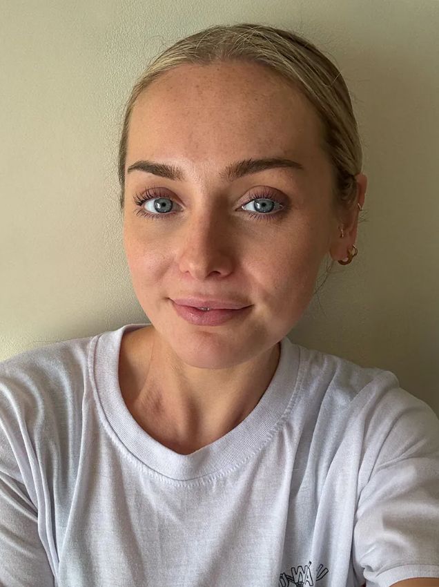 I’d Never Heard of Perioral Dermatitis, until I Was Diagnosed with it